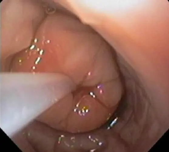 Insémination transcervicale par endoscopie